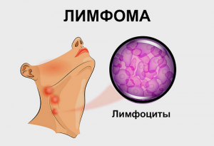 Причины развития лимфомы и как распознать заболевание